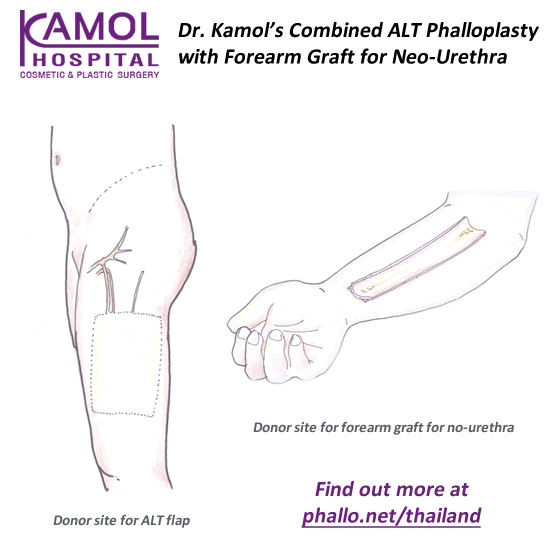 Dr. Kamol's Combined ALT Phalloplasty, with Forearm Graft for Neo-Urethra