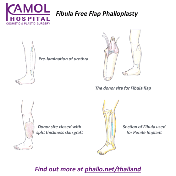 Fibula Free Flap Phalloplasty Thailand