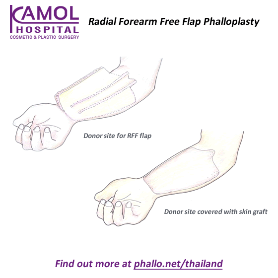 Radial Forearm Flap (RFF) Phalloplasty Thailand