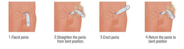 ZSI 100 FTM Malleable Penile Implant