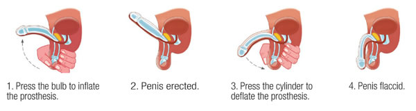 ZSI 475 FTM Hydraulic Penile Implant