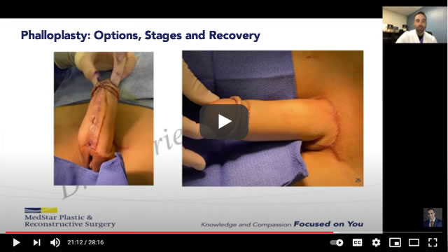 Phalloplasty options, stages and recovery