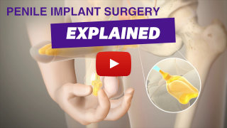 Penile Implant Surgery Explained