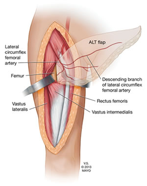 Source: Preoperative planning of a pedicled anterolateral thigh (ALT) flap for penile reconstruction with the multidetector CT scan.