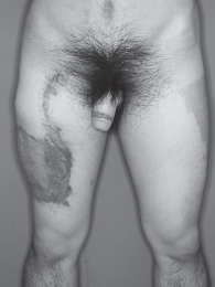 ALT phalloplasty results at 10 months post-op. Source: Phalloplasty with an Innervated Island Pedicled Anterolateral Thigh Flap in a Female-to-Male Transsexual
