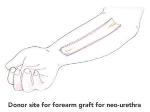 Combined ALT/Forearm Phalloplasty