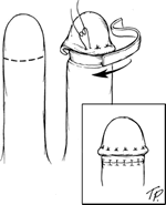 To create a glans, the distal portion of the flap is deepithelialized and then curled under. A full thickness skin graft, harvested from the groin is then placed just below.
