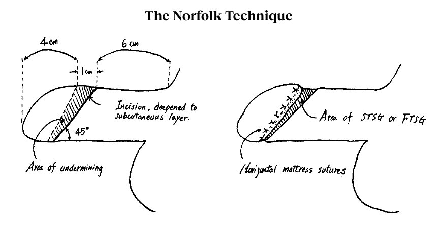 Glansplasty - Norfolk Technique