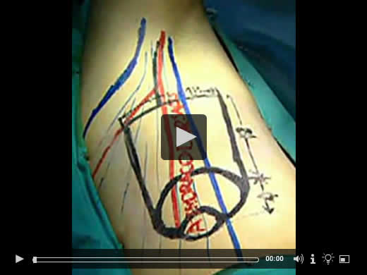 VIDEO: Total Phalloplasty Using a Musculocutaneous Latissimus Dorsi Flap