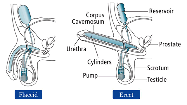 Diagram of Coloplast Titan OTR