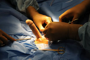 FTM Phalloplasty: Penile Implant Surgery