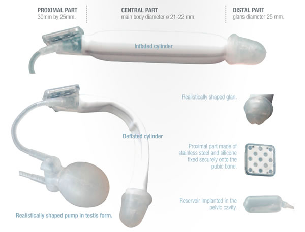 ZSI 475 FTM Hydraulic Penile Implant