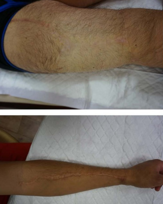 Phalloplasty with pre-expansion results