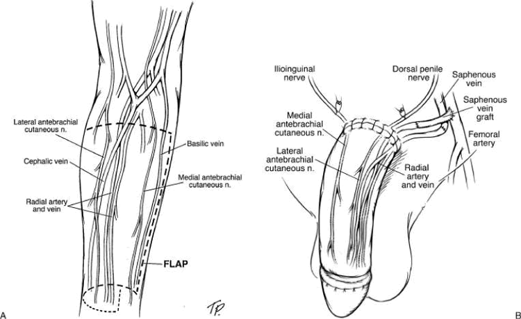 RFF Phalloplasty