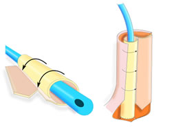 Tube-within-a-tube Phalloplasty